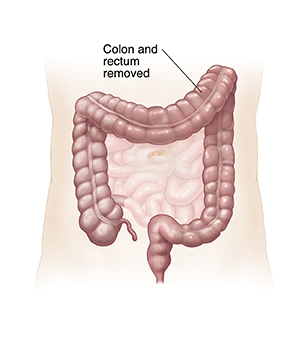 Front view of lower digestive tract with colon and rectum removed, showing ileoanal pouch.