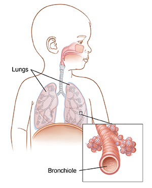 Outline of baby's upper body showing respiratory anatomy and inset showing closeup of bronchiole.