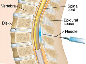 Cross section of lower spine with needle inserted just outside sac surrounding spinal cord.