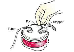 Closeup of gloved hand opening stopper on a full hemovac drain.