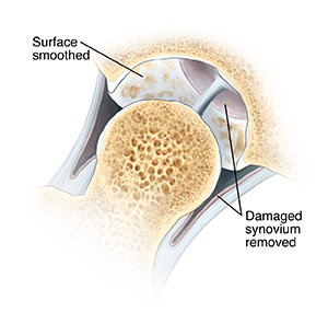 Cross section of hip joint with femoral head moved out of socket. Cartilage lining socket is smoothed. Damaged synovium is removed.