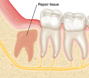 Closeup cross section of jawbone and molars showing repair tissue where wisdom tooth was removed.