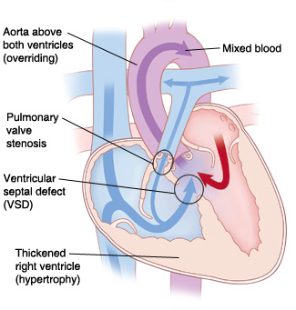 Front view cross section of heart showing Tetralogy of Fallot: aorta above both ventricles, pulmonary stenosis, ventricular septal defect (VSD), and thickened right ventricle. Arrows show blood flowing from left and right sides of heart through VSD to mix and be pumped out of aorta. Some blood flows from right side of heart to pulmonary artery.