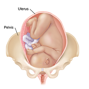 Front view of full-term fetus in uterus in pelvic bones, with head down.