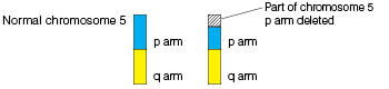 Graphic showing normal chromosome with p arm and q arm, compared to chromosome with part of p arm deleted. 