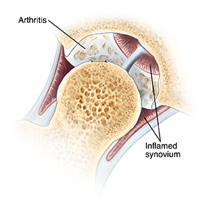 Cross section of hip joint with femoral head moved out of socket. Cartilage lining socket is damaged. Synovium lining joint is inflamed.