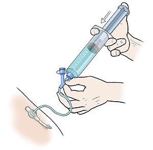 Close-up of hands holding twist-on syringe in feeding tube port, pressing plunger to flush water into feeding tube.