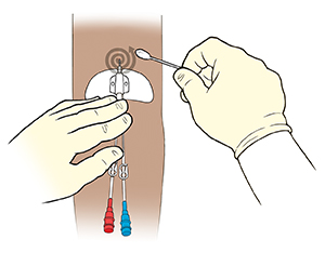 Closeup of arm with midline catheter. One gloved hand holding catheter against arm while other gloved hand cleans around site with a swab. Arrow shows cleaning in a spiral motion moving out from the insertion site.