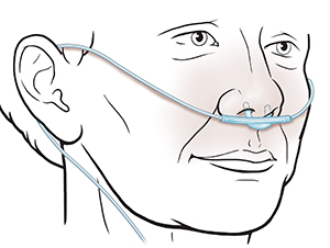 Three-quarter view of face showing proper placement of nasal cannula.