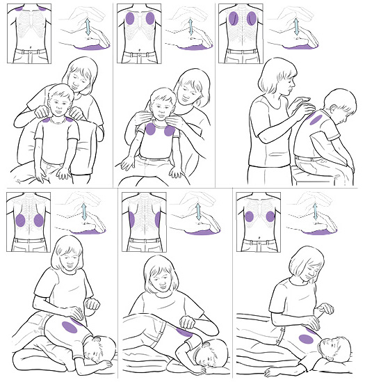 How to do chest percussions to help your child drain mucus from the lungs