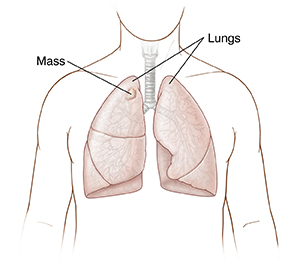Front view of chest showing lungs with mass on right lung.
