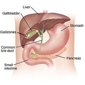 Outline of torso showing liver and stomach with cross section of gallbladder with stones.