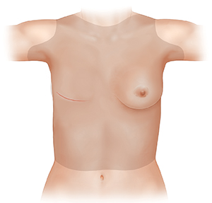 Woman's torso with shading over area to examine after mastectomy.