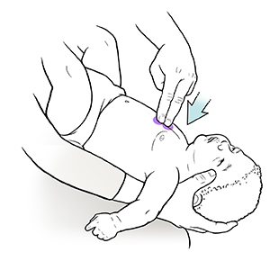 Closeup of adult holding infant face up on lap, pressing two fingers at lower end of baby's breastbone.