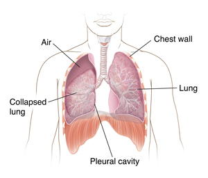 Front view of male chest showing partially collapsed right lung.