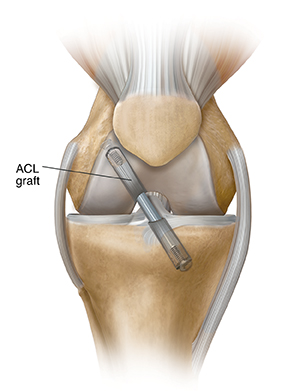 Front view of knee showing graft repair of anterior cruciate ligament.