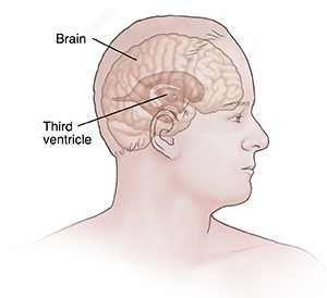 Side view of head showing third ventricle in brain.