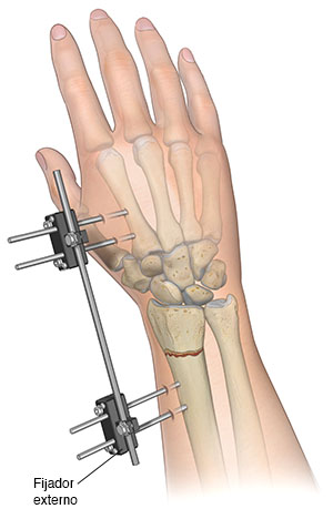 Vista posterior de un antebrazo donde puede verse un fijador externo que sostiene el radio fracturado en su lugar.