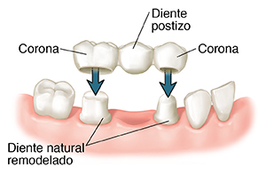 Primer plano de un puente que se coloca sobre los dientes preparados.