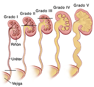 Corte transversal de riñones y uréteres en donde se ven cinco grados de reflujo vesicoureteral.