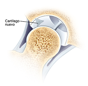 Corte transversal de una articulación de cadera en donde se ve la cabeza del fémur que se separó de la cavidad de la cadera. Se formó cartílago nuevo en la zona donde se hicieron agujeros pequeños.