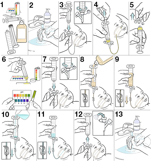 13 pasos para alimentar a un bebé con una sonda nasogástrica.
