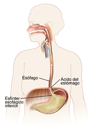 Contorno de una mujer donde pueden verse la boca, el esófago y el estómago. Unas flechas muestran el ácido del estómago que sube al esófago e irrita la parte posterior de la garganta.