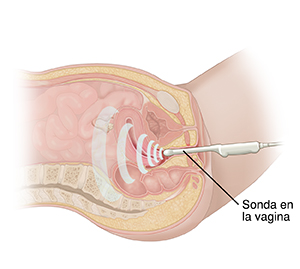 Corte transversal de una pelvis femenina vista de lado. Hay un transductor de ultrasonido en la vagina.