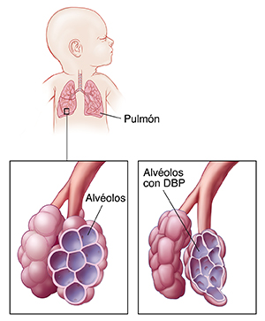 Vista frontal de la cabeza y el tórax de un recién nacido en la que pueden verse los pulmones con un recuadro que muestra alvéolos normales y otro recuadro que muestra displasia broncopulmonar.