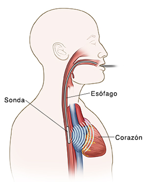 Vista lateral de cabeza y pecho de un hombre donde puede verse una sonda en el esófago para realizar una ecografía transesofágica.