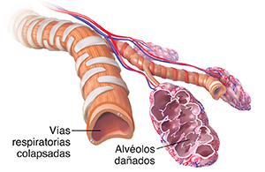 Bronquiolos y alvéolos colapsados con enfisema.