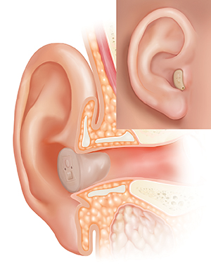 Cross section of ear showing outer ear structures with in-the-canal hearing aid in place and inset of external view.Cross section of ear showing outer ear structures with in-the-canal hearing aid in place and inset of external view.